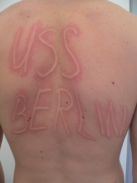 Abbildung 10 a und b: Symptomatischer Dermographismus (Urticaria factitia). Wenige Minuten nach dem „Schreiben“ erscheint der Schriftzug als Quaddel auf der Haut. Bild a direkt nach dem „Schreiben“, Bild b 5 Minuten später. (Quelle: Allergie Centrum Charité)