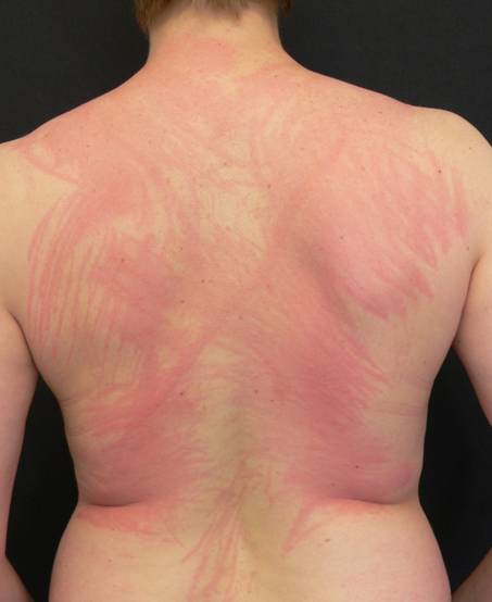 Abbildung 11a: Symptomatischer Dermographismus (Urticaria factitia) (Quelle: Allergie Centrum Charité)